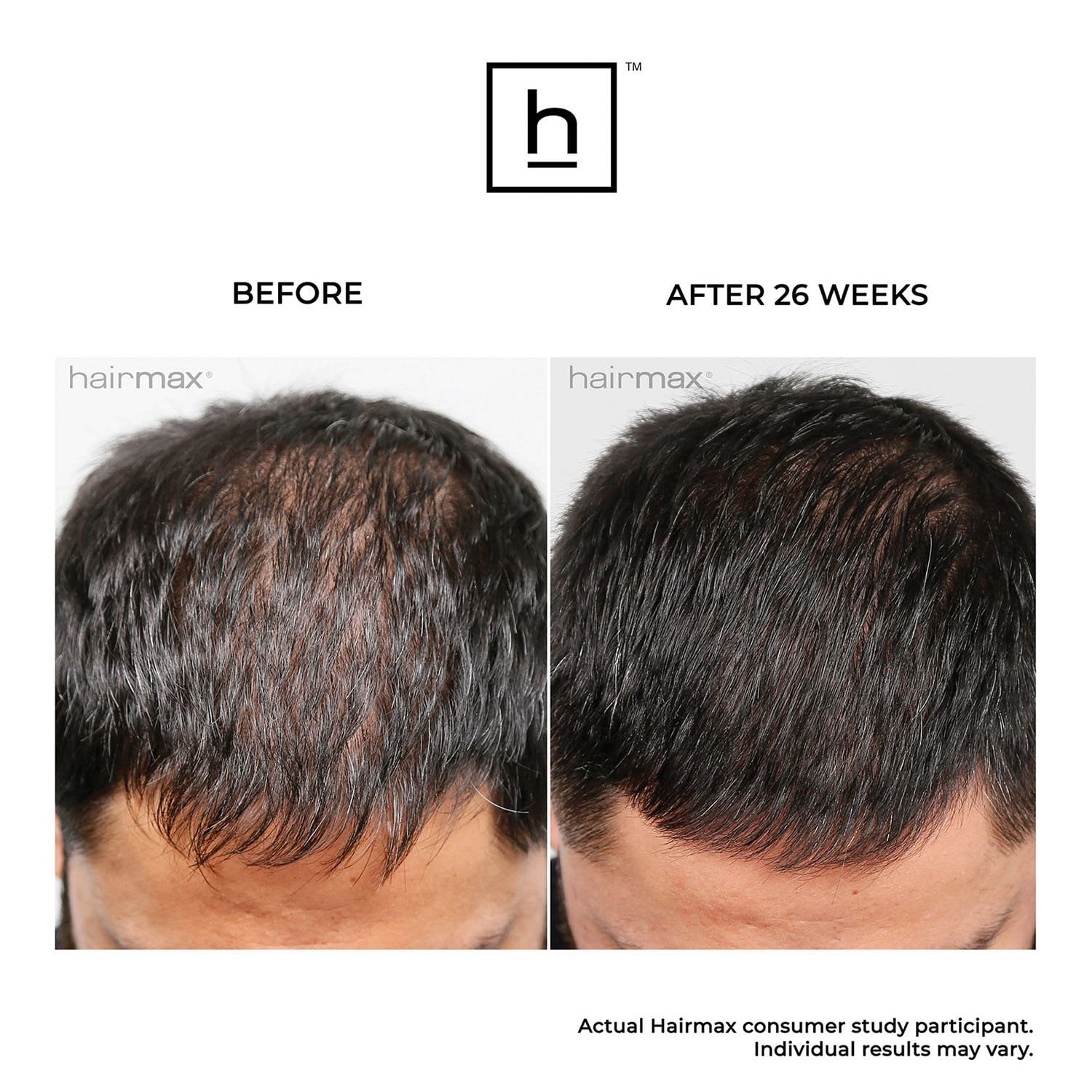 Hairmax Pro 12 LaserComb Hair Growth Bundle -