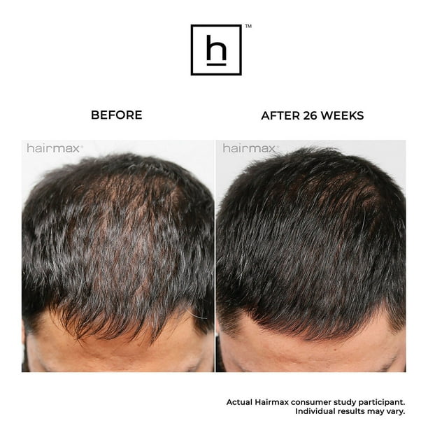 Hairmax Pro 12 LaserComb Hair Growth Bundle - Samsclub.com
