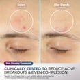 thumbnail image 9 of Shark CryoGlow Under-Eye Cooling + LED Anti-Aging & Skin Clearing Face Mask, 9 of 13