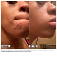 thumbnail image 3 of Urban Skin Rx 3-in-1 Clear Skin Cleansing Bar, 2 oz., 2 pk., 3 of 7
