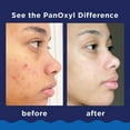 thumbnail image 5 of PanOxyl Acne Foaming Wash, 10% Benzoyl Peroxide, 5.5 oz., 2 pk., 5 of 6