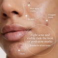 thumbnail image 6 of Neutrogena Evenly Clear Acne-Prone Skin Essentials Set, 6 of 9