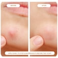 thumbnail image 4 of NIGHT Pimple Patches, for Toughest Acne, 48 ct., 4 of 7