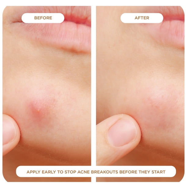 NIGHT Pimple Patches, for Toughest Acne, 48 ct. NIGHT Pimple Patches, for Toughest Acne, 48 ct.
